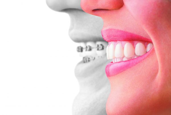 Invisalign compare to braces