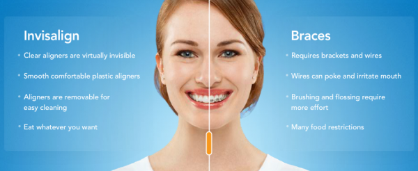 nvisalign Advantage_Over_Braces